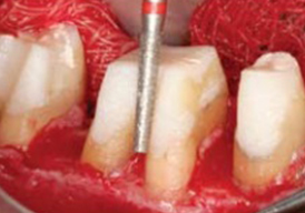 periodontal-1