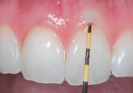 periodontal-2